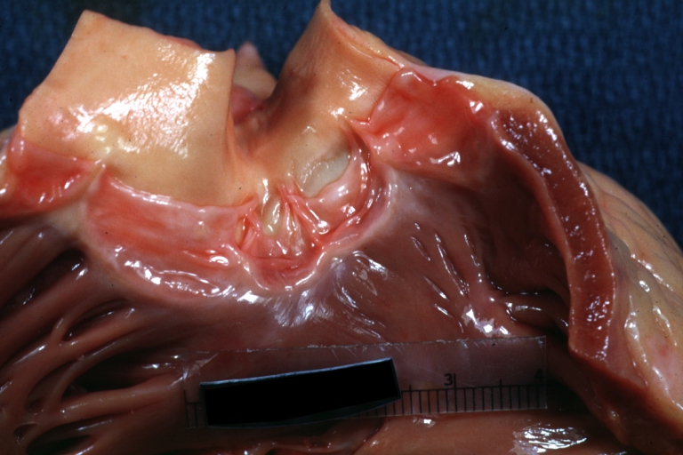 Quadricuspid pulmonary valve. Image courtesy of Professor Peter Anderson DVM PhD and published with permission © PEIR, University of Alabama at Birmingham, Department of Pathology