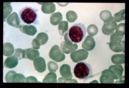 Hairy cell leukemia illustrated on a blood film[9]