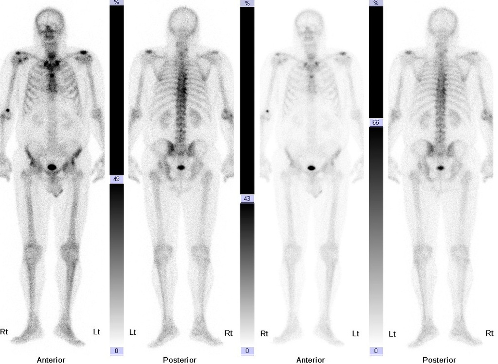 File:Paget-disease-of-the-bone.jpg