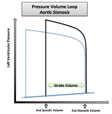 Pressure-volume loop in aortic stenosis. Note that the normal pressure volume diagram is in dotted line.