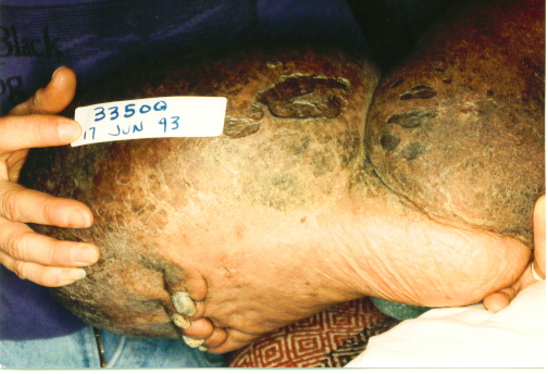 Another view of lymphedemic foot