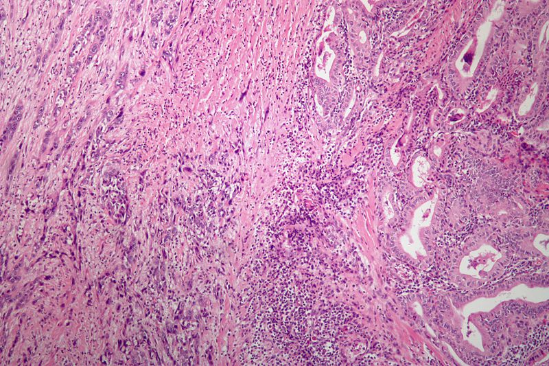 Anaplastic thyroid carcinoma with a component of PTC. (WC)