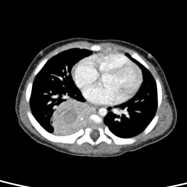 Neuroblastoma observed as a large right enhancing mass with central hypo-attenuation on transverse thoracic CT scan[2]