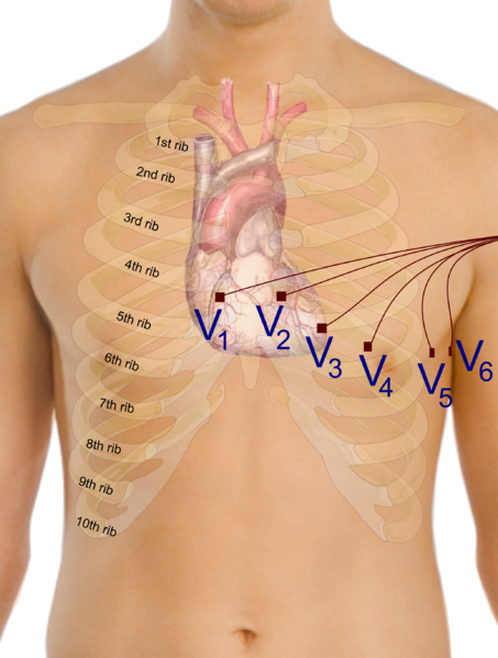 The position of the six chest electrodes