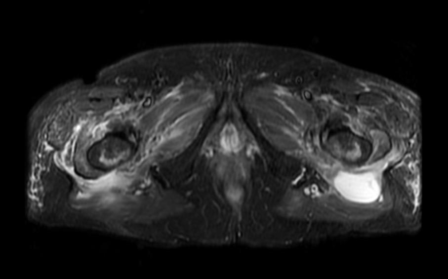File:Greater trochanter bursitis MRI 003.jpg