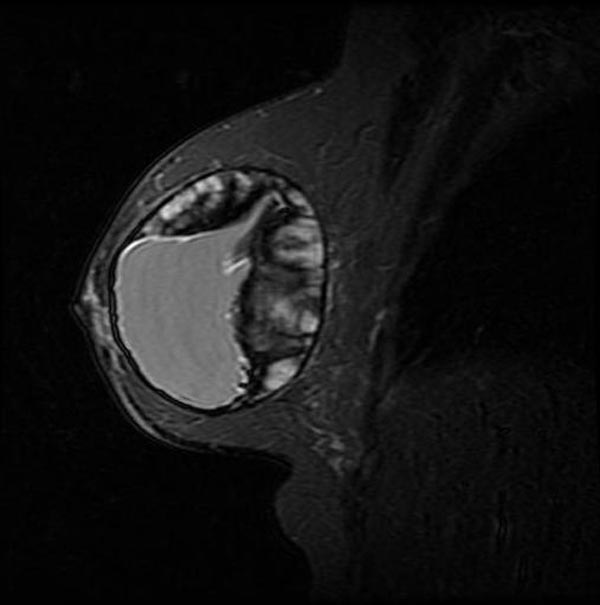 MRI: Breast implant rupture: Intracapsular rupture