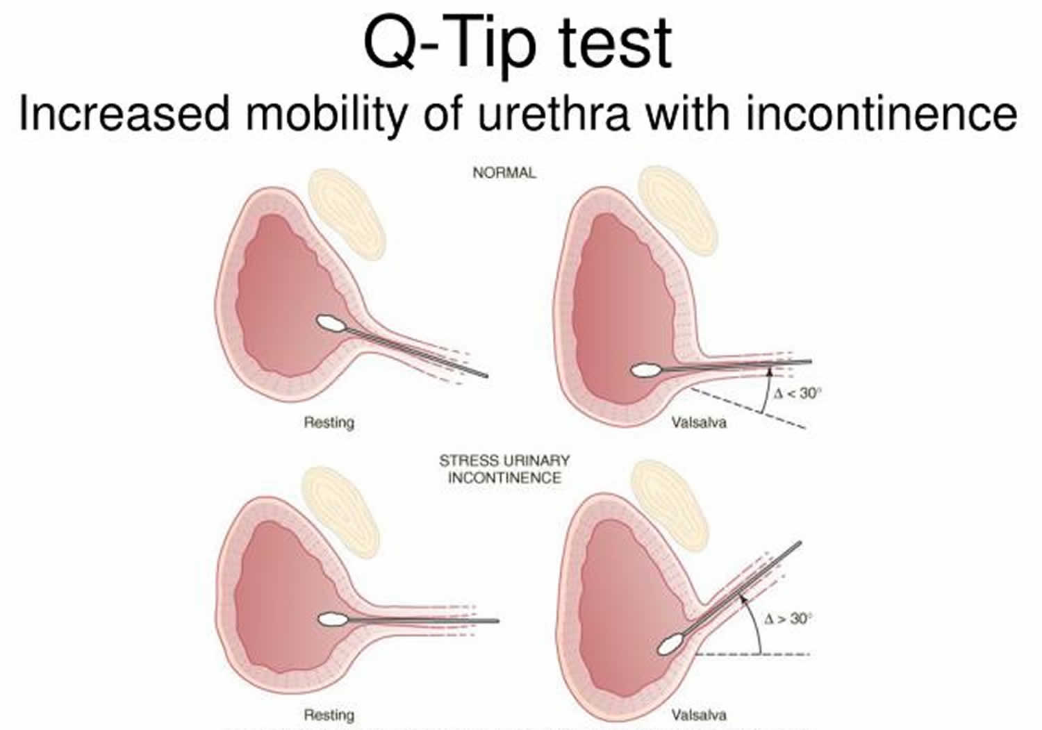 File:Q-tip-test-urethral-hypermobility.jpg