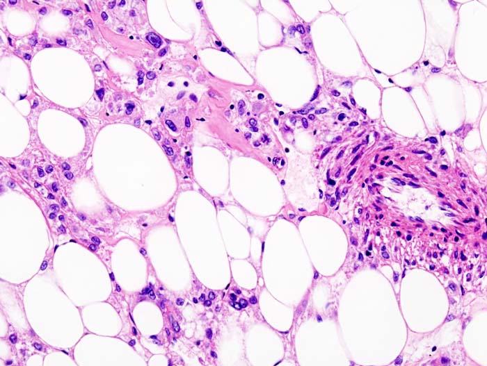 Histopathologic slide of renal angiomyolipoma. Nephrectomy specimen. H & E stain.