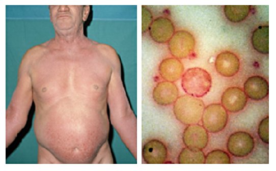 File:Sézary's disease- PAS stain.jpg