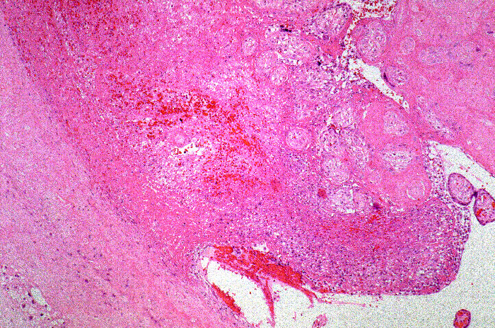 Photomicrograph describing tuberculosis of the placenta.Adapted from Public Health Image Library (PHIL), Centers for Disease Control and Prevention.[26]