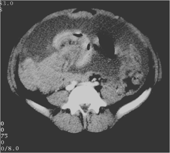 CT: Thickened peritoneum and ascites. Burkitt's lymphoma