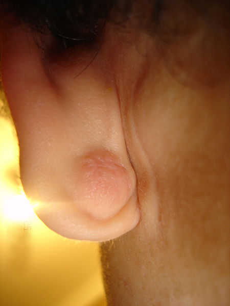 Epidermal Cyst ear.JPG