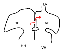 Sketch showing foramen ovale in a fetal heart. Red arrow shows blood from the inferior caval vein. HV: right atrium, VF: left atrium. HH og VH: right and left ventricle. The heart still has a common pulmonary vein (LV), in stead of four.