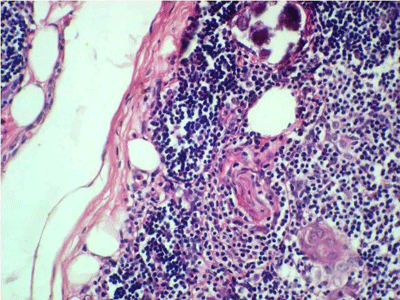 File:Histopathology of thymic cyst.gif