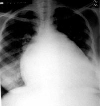 Cardiomegaly;Chest x-ray. Image courtesy of C. Michael Gibson MS. MD