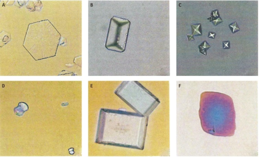 Type of stones. Light microscopy of urine crystals. (A) Hexagonal cystine crystal (200X); (B) coffin-lid shaped struvite crystals (200X); (C) pyramid-shaped calcium oxalate dehydrate crystals (200X); (D) dumbbell-shaped calcium oxalate monohydrate crystal (400X); (E) rectangular uric acid crystals (400X); and (F) rhomboidal uric acid crystals (400X).[8]