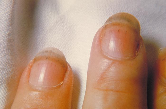 Splinter hemorrhages under the finger nails