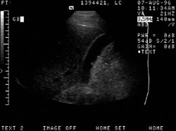 51-year-old male with right lower quadrant pain. Two small polyps are seen within the gallbladder (the largest of which measures 7mm)