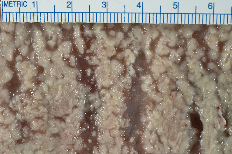 Pseudomembranous colitis. [35]