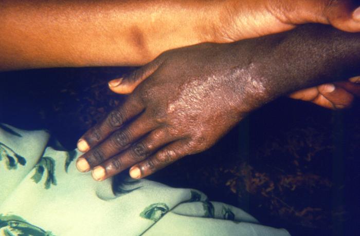 Active cutaneous lesion on left hand consistent with tuberculoid or paucibacillary leprosy.Adapted from Public Health Image Library (PHIL), Centers for Disease Control and PreventionPublic Health Image Library (PHIL), Centers for Disease Control and Prevention[5]