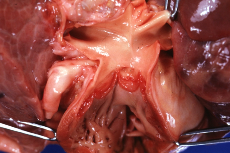 Pulmonary vein stenosis: Gross, natural color, pulmonary outlet showing thickened pulmonary arteries