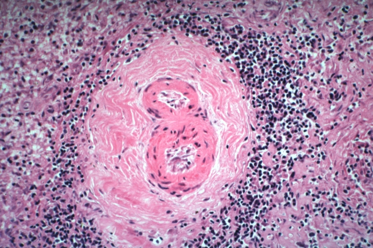 Spleen: Lupus Erythematosus Periarterial Fibrosis: Micro high may H&E. An excellent example of periarterial fibrosis