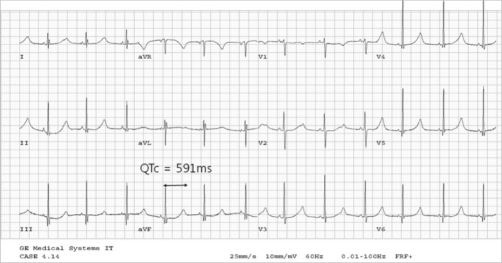 File:ECG in Jervell and Lange-Nielsen syndrome.gif