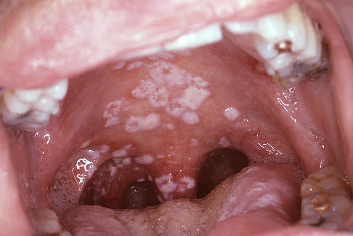Oral pseudomembraneous candidiasis infection. From Public Health Image Library (PHIL). [2]