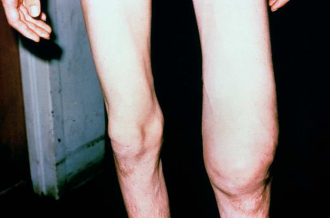 This is a photograph of the patient prior to surgery. Note the marked swelling of the knee.