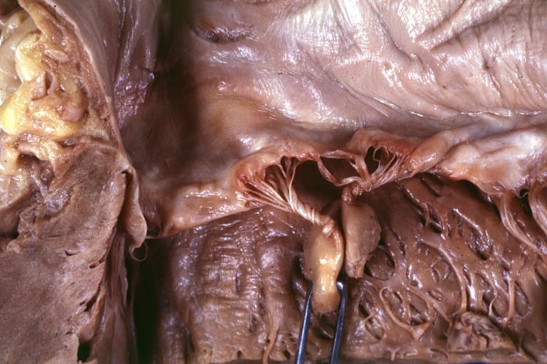 Papillary Muscle Infarct with Rupture: Gross, fixed tissue, but good color. An outstanding photo of ruptured head of posterior papillary muscle with entwined chordae