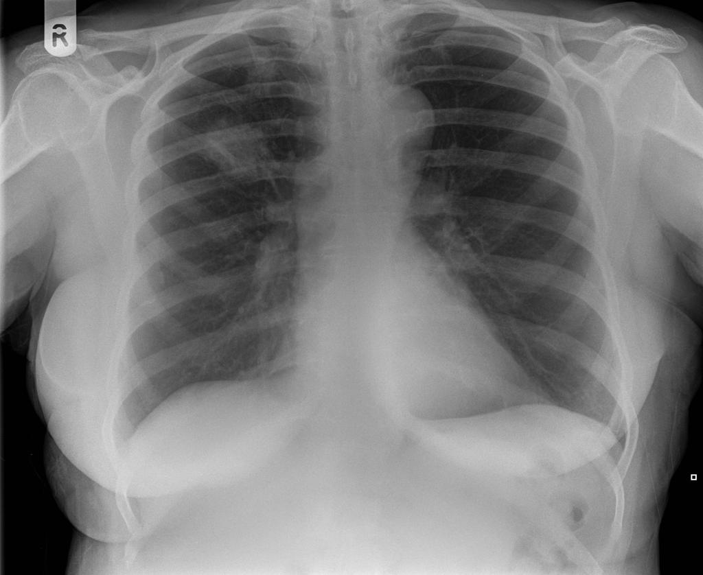 Coin lesion sign: round or oval, well-circumscribed lesion, compatible with primary lung cancer. Case courtesy of Dr Ian Bickle. Source:Radiopedia.org [9]