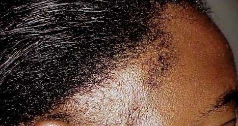 File:Traumatic alopecia01.jpg