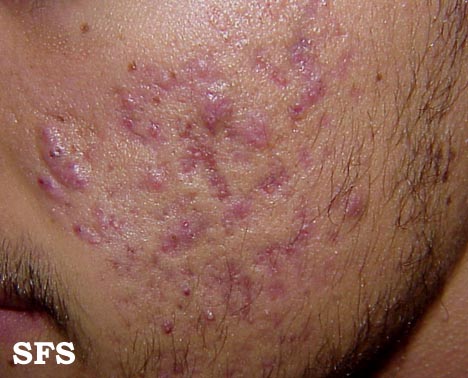 Acne vulgaris. Adapted from [http://www.atlasdermatologico.com.br/disease.jsf?diseaseId=3