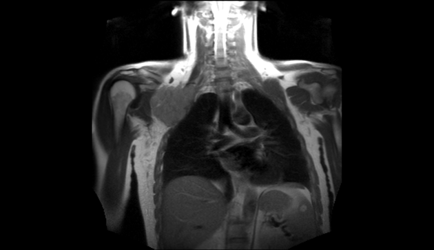 File:Anaplastic large cell lymphoma MRI scan .png