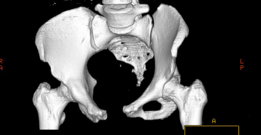 File:Diastasis of the pubic symphysis CT 006.jpg