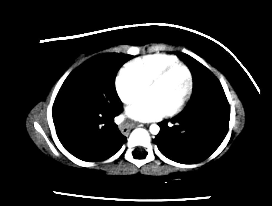 File:Esophageal leiomyomatosis CT 002.jpg