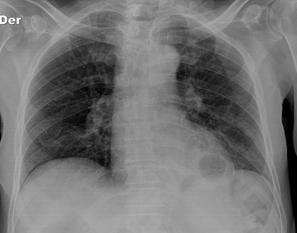 File:Non-Hodgkin lymphoma chest-x ray.jpeg