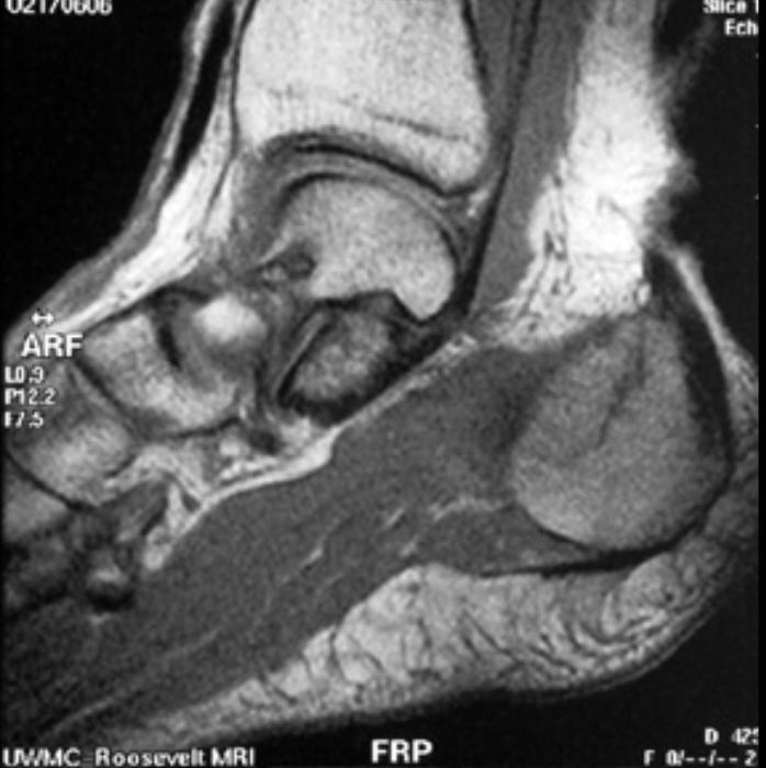 MRI reveals a calcaneal stress fracture