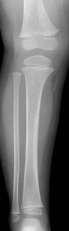 X-ray: Toddler's fracture