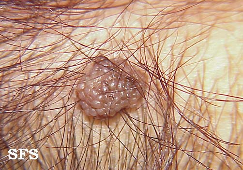 Melanocytic Naevi. With permission from Dermatology Atlas<ref name="www.atlasdermatologico.com.br">"Dermatology Atlas".
