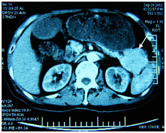 Computed tomography scan of the abdomen showing a large tumor in the tail of the pancreas[7]