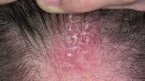 Scalp showing redness and crusting