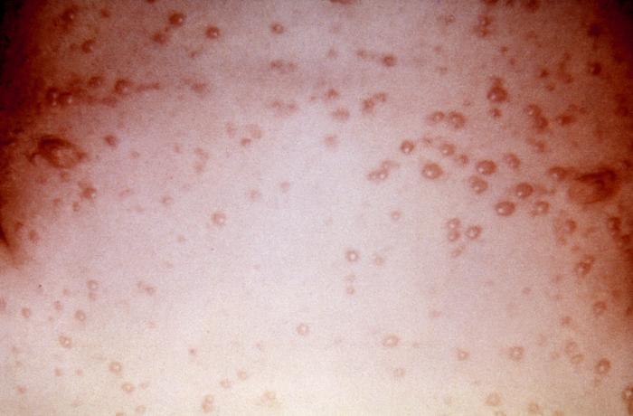 This 7 year old child presented with a generalized herpes simplex vesiculopapular rash over his trunk 5 days after onset. Herpes simplex virus, otherwise known as “Herpesvirus hominis” is a member of a group of viruses including those which cause oral herpes, i.e., usually HSV-1, and genital herpes, i.e., usually HSV-2.