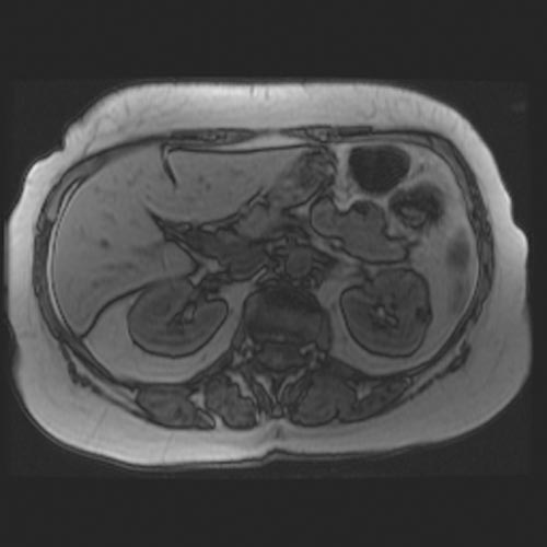 MRI: Angiomyolipoma Image courtesy of Radswiki Radiopaedia(original file "here"). Creative Commons BY-SA-NC[1]