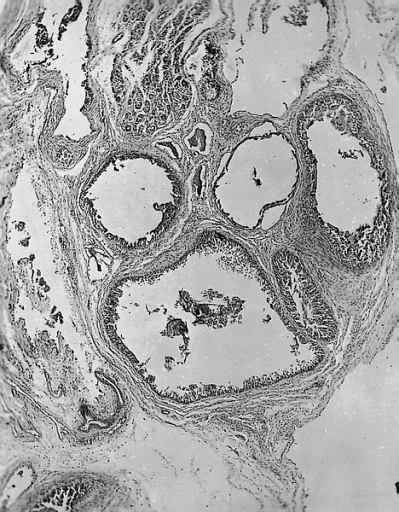 Heart-Great Vessels: Bronchogenic cyst; The lining cells are cuboidal, and the cysts are surrounded by muscle and may contain underlying seromucous glands.