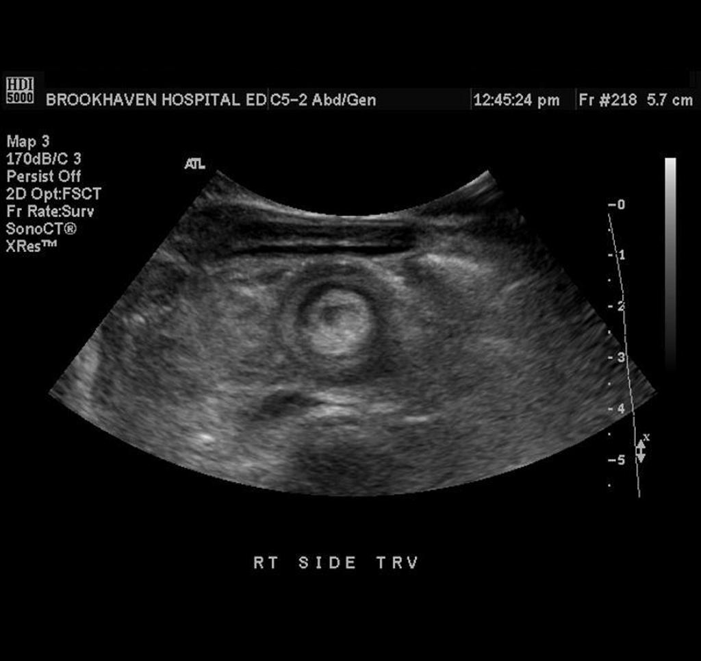 File:Intussusception- Transverse view .jpg