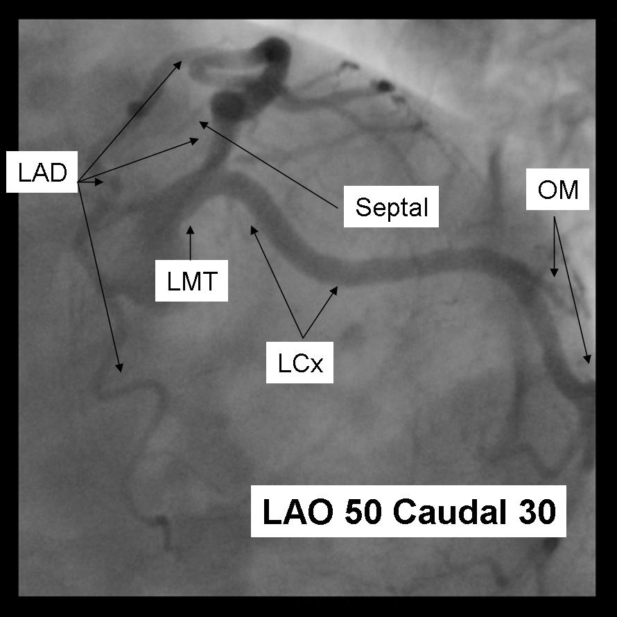 A coronary angiogram that shows the LMCA, LAD and LCX