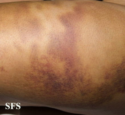 Painful bruising syndrome. Permission from from Dermatology Atlas.[5]