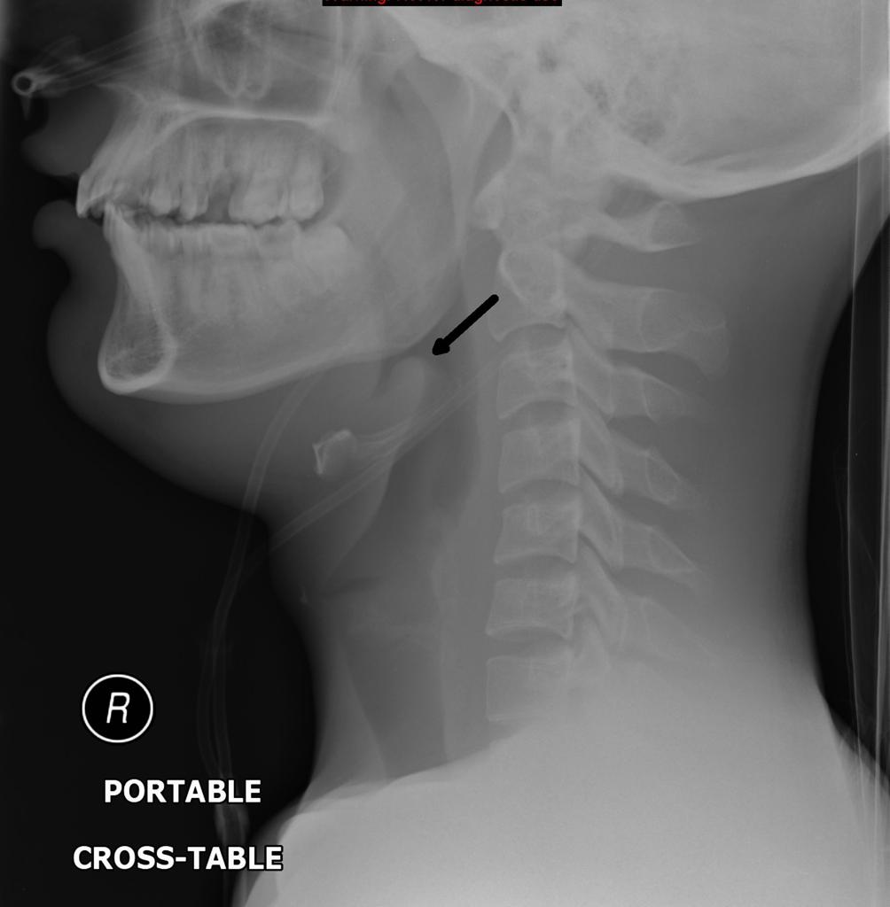 File:Epiglottitis-in-adult.jpg