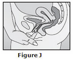 File:Etonorgestrel and Ethinyl Estradiol Vaginal Ring Image5.png